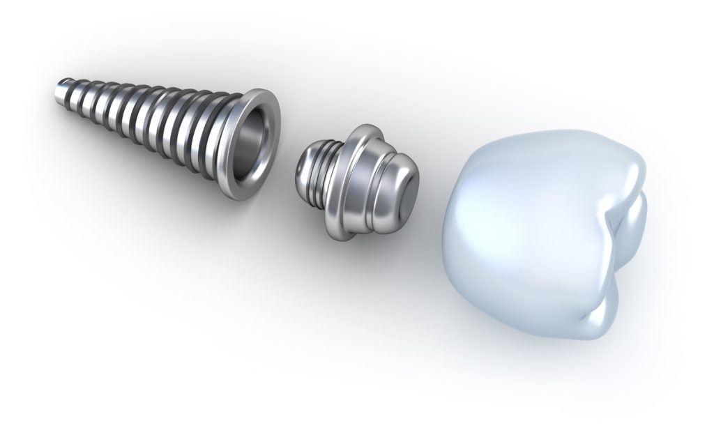 implant-abutment-1024x614